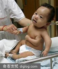 Baby Born With Third Arm